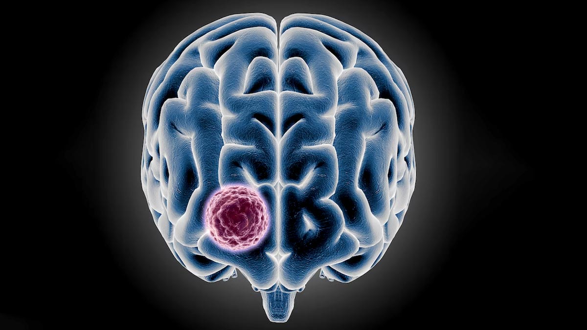 Separating Facts From Fiction: Expert Debunks Myths About Brain Tumour