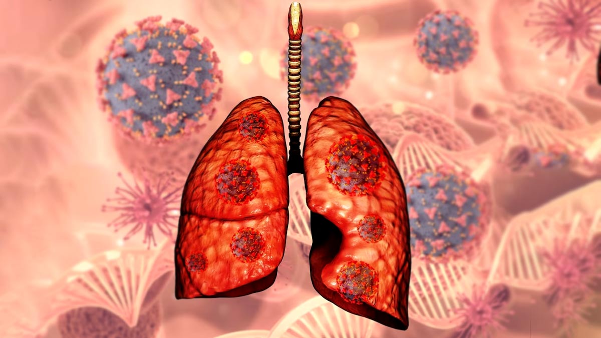 World Lung Cancer Day: Expert Lists Types And Stages Of This Cancer