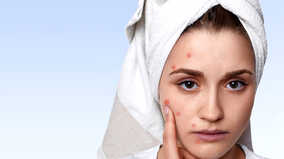 Natural Remedies for Stress Pimples: மன அழுத்தத்தால் ஏற்படும் பருவை போக்க சிறந்த வழிகள்!